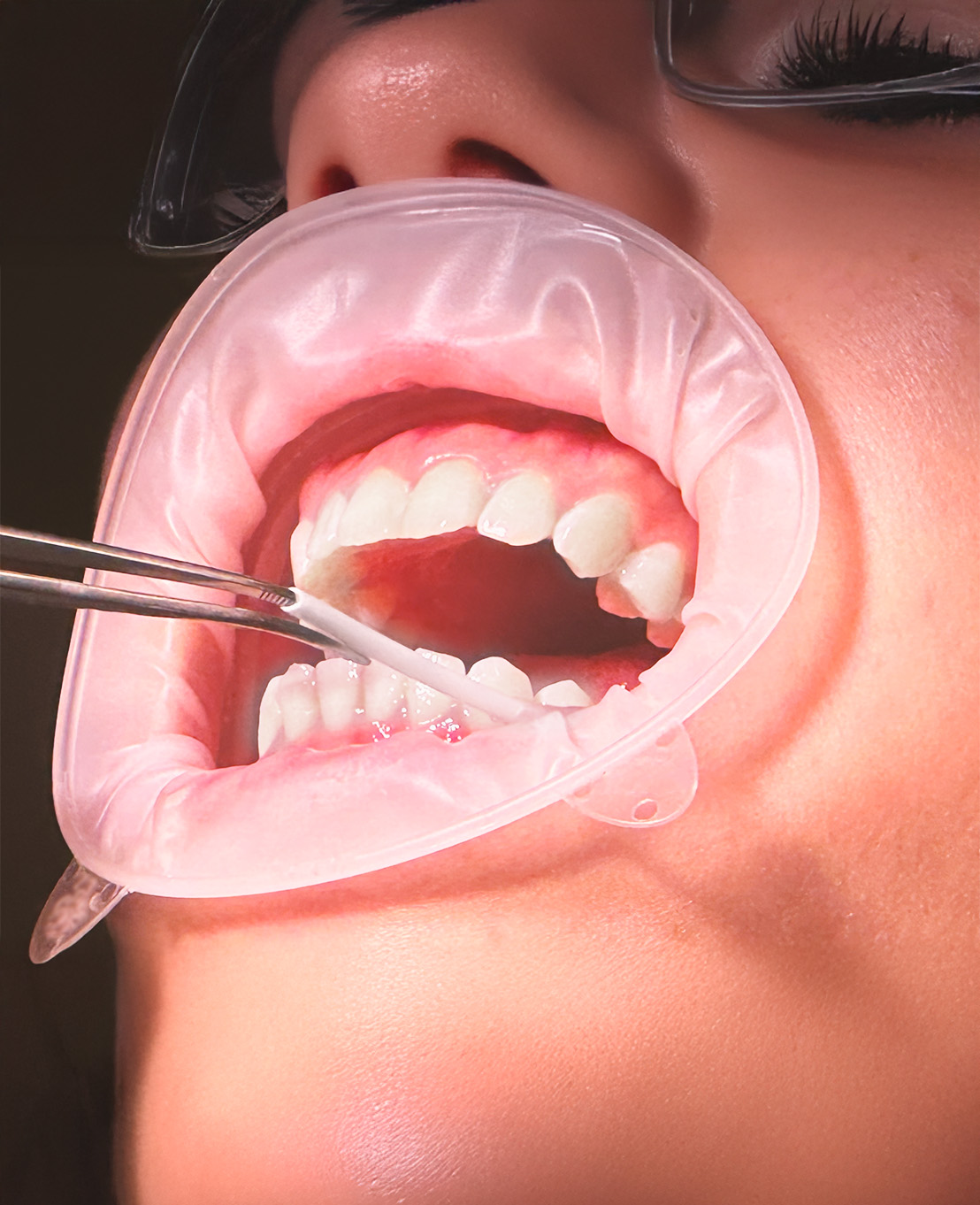 Comfitract-Latex-Free-Cheek-Retractor-Applied