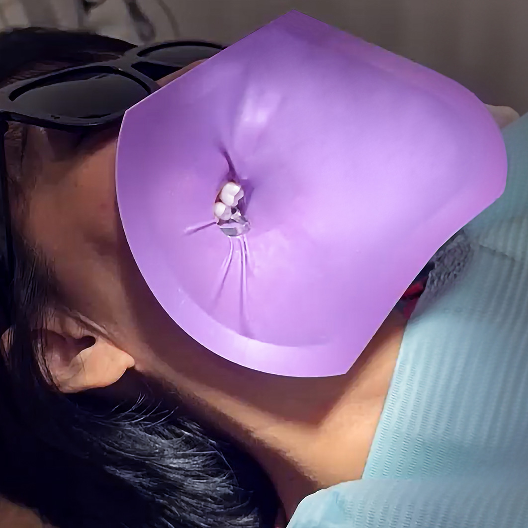 Pre-framed-Dental-Dam-Patient